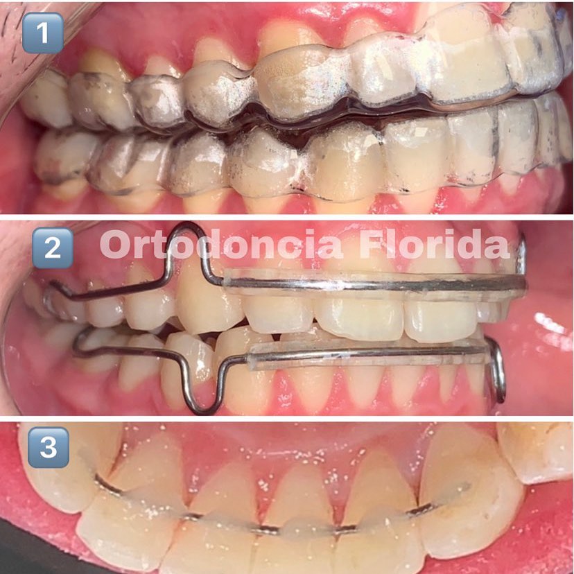 mesa Parlamento Impedir Tipos de contenciones finales en ortodoncia - Ortodoncia Florida -  Alineadores Invisalign - Proveedor Oficial